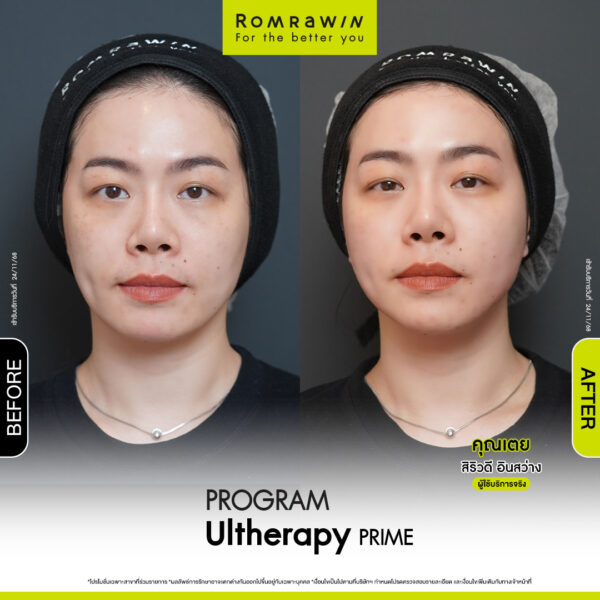 Review ulthera prime คุณเตย