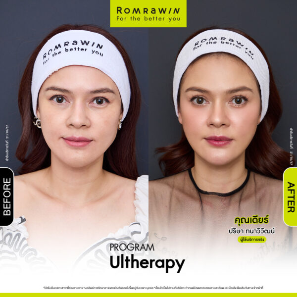 รีวิว อัลเทอร่า คุณเดียร์