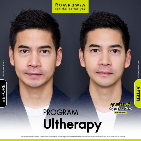 รีวิว อัลเทอร่า คุณฟรอยด์