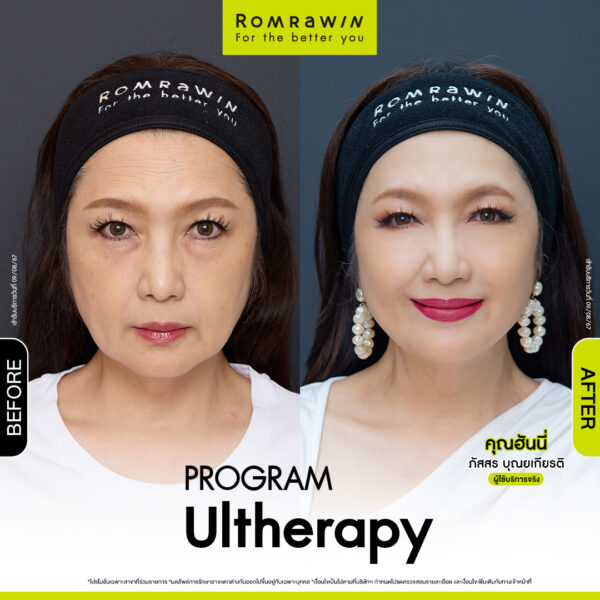 รีวิว อัลเทอร่า คุณฮันนี่