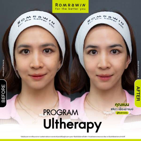 รีวิว อัลเทอร่า คุณแนน