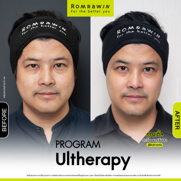 รีวิว อัลเทอร่า คุณเติ้ล