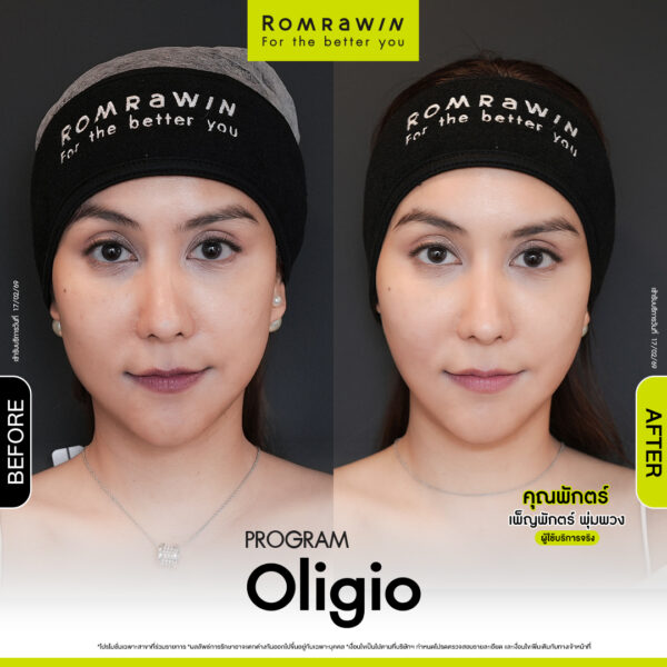รีวิว Oligio คุณพักตร์