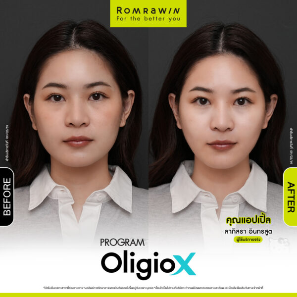 รีวิว Oligio X คุณแอ๊ปเปิ้ล