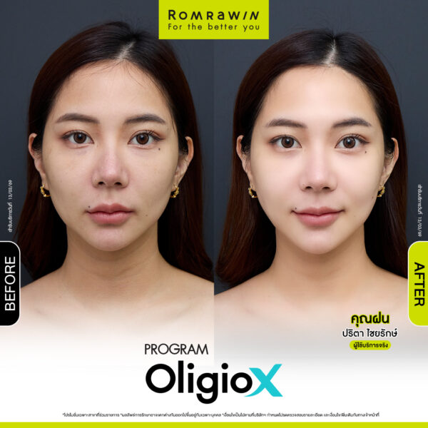 รีวิว Oligio X คุณฝน