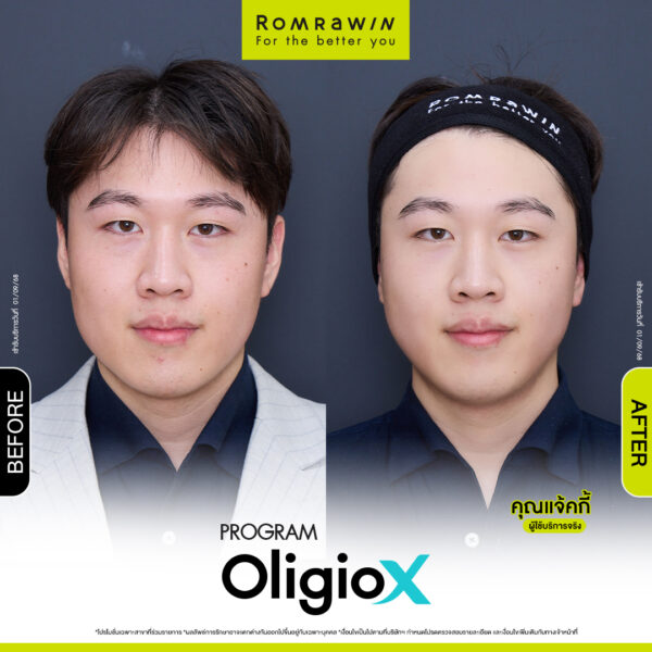 รีวิว Oligio X คุณแจ้คกี้