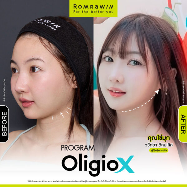 รีวิว Oligio X คุณไข่มุก