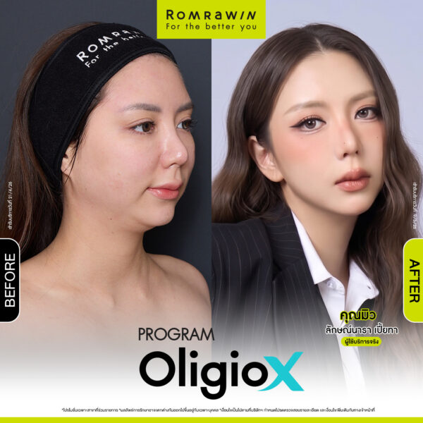 รีวิว Oligio X คุณมิว