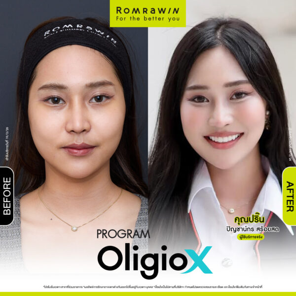 รีวิว Oligio X คุณปริ๊น