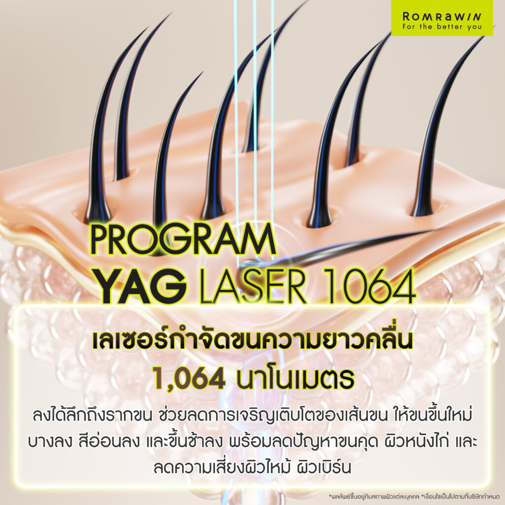 2 Step Smooth & Bright เคลียร์ขนกวนใจ พร้อมกู้ผิวเนียนใส ไร้ขนคุด 5 เลเซอร์ขน YAG Laser 1064 คืออะไร?