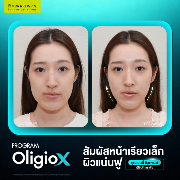 X Mode เทคโนโลยีใหม่ของ OligioX ดียังไง ทำไมใครๆถึงถูกใจ 5 รีวิว OligioX