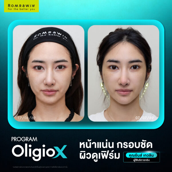 X Mode เทคโนโลยีใหม่ของ OligioX ดียังไง ทำไมใครๆถึงถูกใจ 3 รีวิว Oligio X