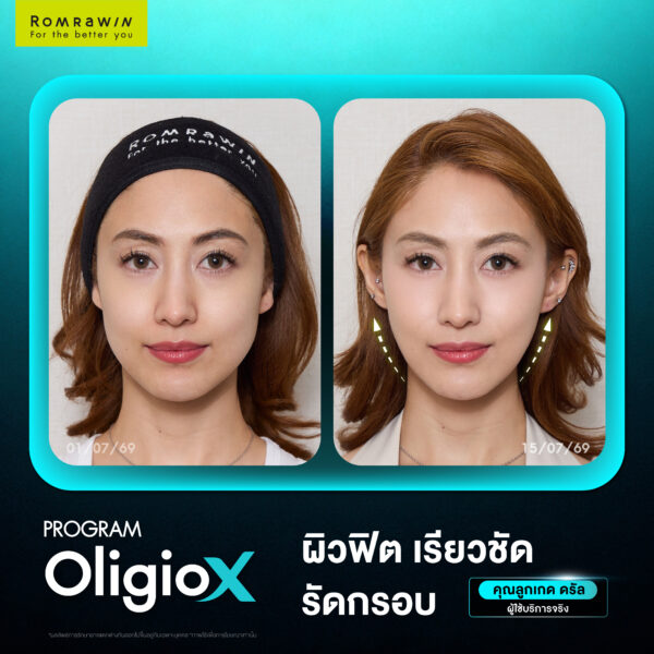 X Mode เทคโนโลยีใหม่ของ OligioX ดียังไง ทำไมใครๆถึงถูกใจ 7 รีวิว OligioX