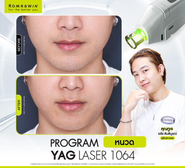 รีวิว Yag Laser 1064 (หนวด) คุณทูเจ
