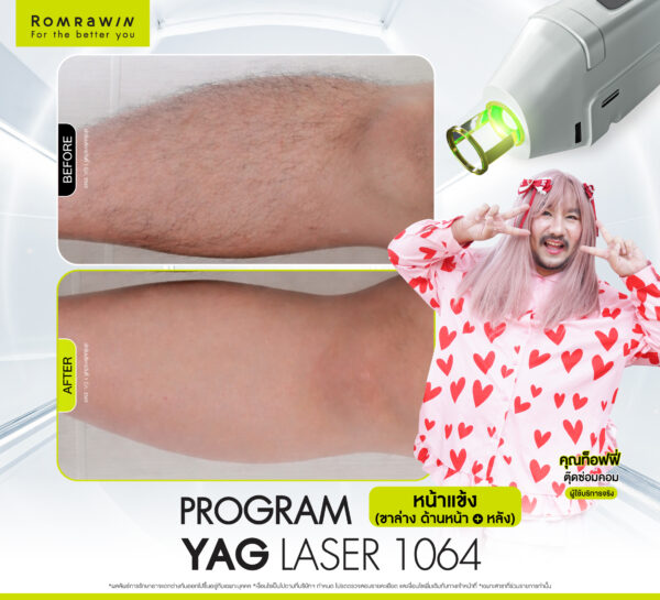 รีวิว Laser Laser 1064 (ขา) คุณท๊อฟฟี่