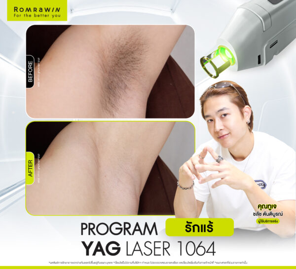 รีวิว Yag Laser 1064 (รักแร้) คุณทูเจ