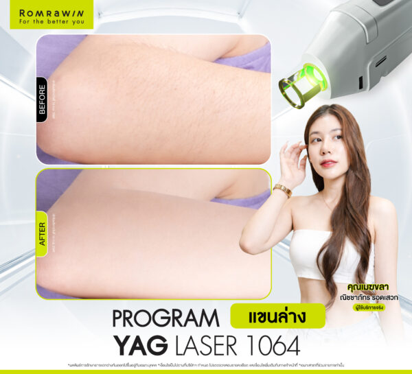 รีวิวYag Laser 1064 (แขน) คุณเมฆลา