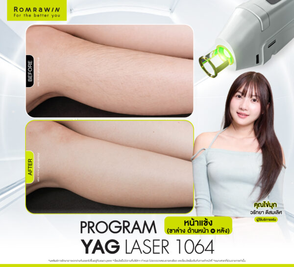 รีวิว Laser Laser 1064 (ขา) คุณไข่มุก