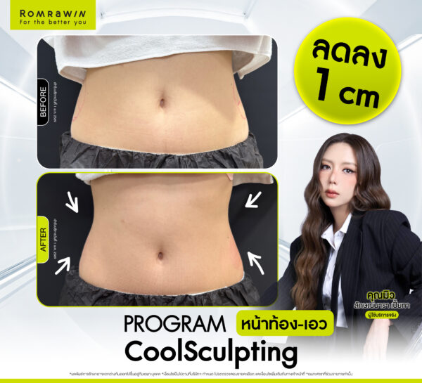 รีวิว Cool Sculpting คุณมิว