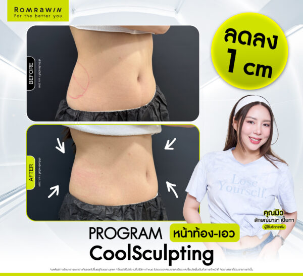 รีวิว Cool Sculpting คุณมิว