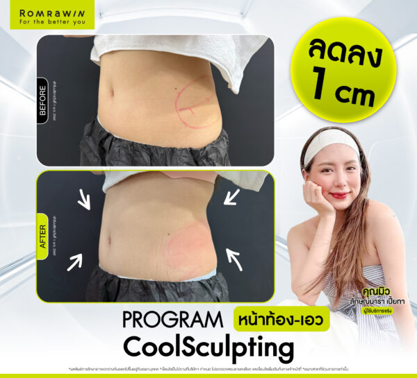 รีวิว Cool Sculpting คุณมิว