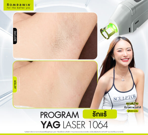 รีวิว Yag Laser 1064 (รักแร้) คุณสปาย