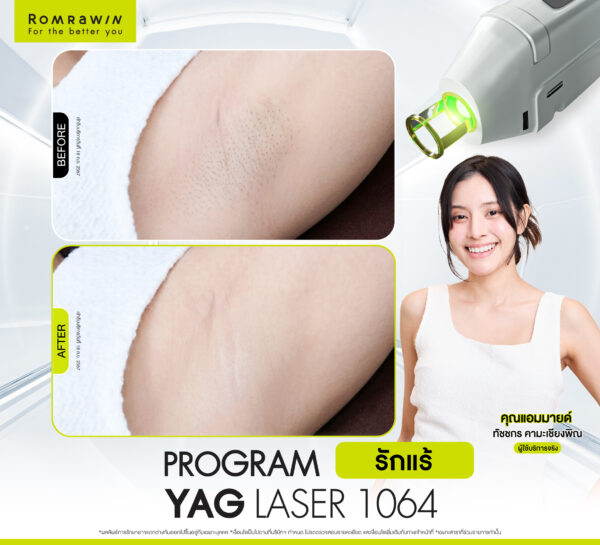 รีวิว Yag Laser 1064 (รักแร้) คุณแอมมายด์