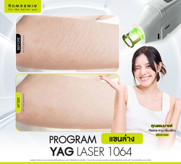 รีวิว Yag Laser 1064 (แขน) คุณแอมมายด์