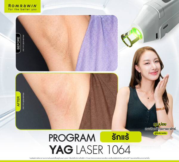 รีวิว Yag Laser 1064 (รักแร้) คุณปอย