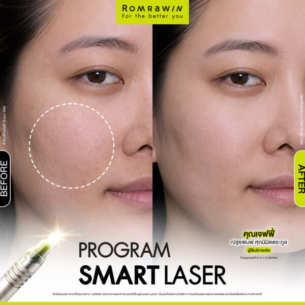 รีวิว SMART LASER คุณเจฟฟี่