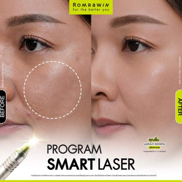 รีวิว SMART LASER คุณยิ้ม