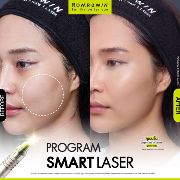 รีวิว SMART LASER คุณปริ๊น