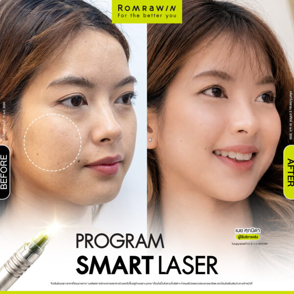 รีวิว SMART LASER คุณเนย
