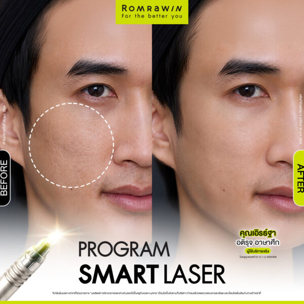 รีวิว SMART LASER คุณเอิรธ์ฐา