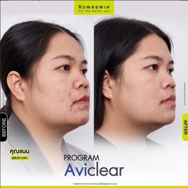 aviclear nan