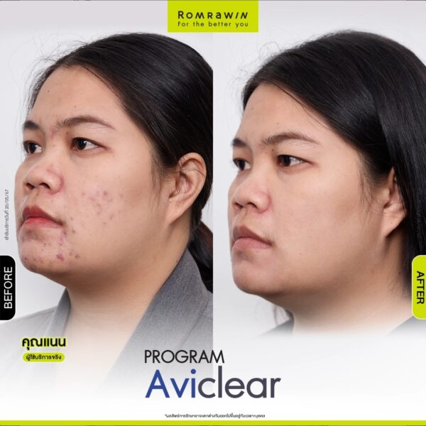 aviclear nan1