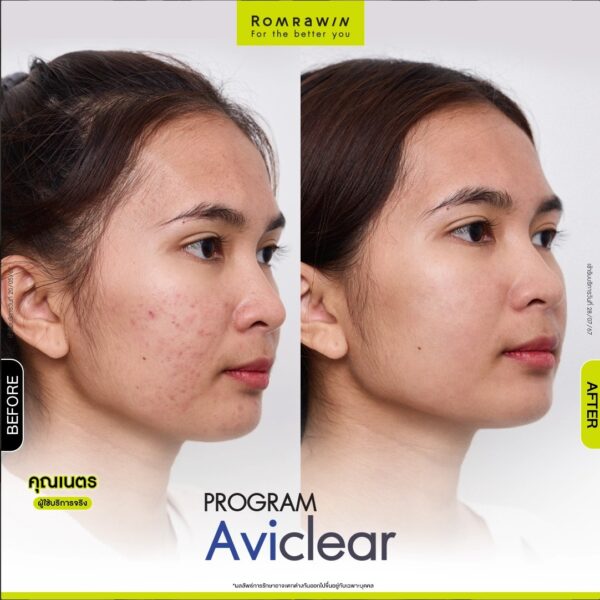 aviclear nate