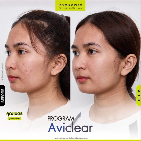 aviclear nate 2