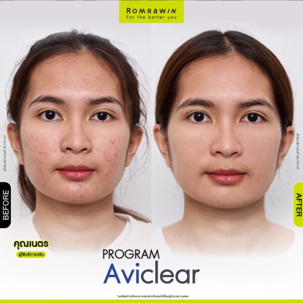 aviclear nate 3