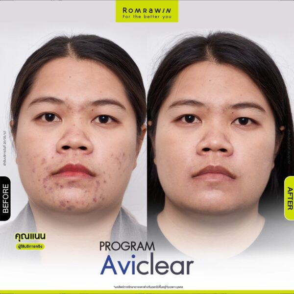 aviclear nate nan