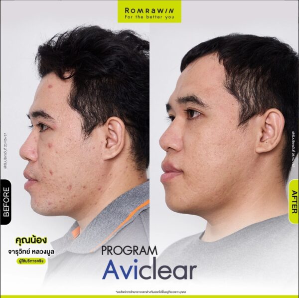 aviclear nong