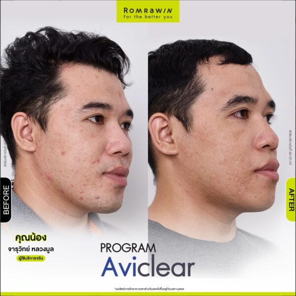 aviclear nong2
