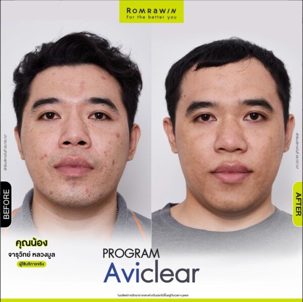 aviclear nong3