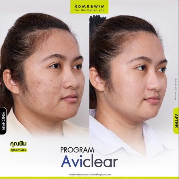 aviclear pim1