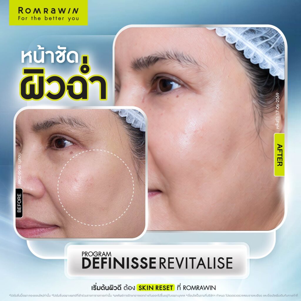 Definisse Revitalise ไหมงานผิว คืนความอ่อนวัยและแข็งแรงให้ผิวถึงระดับโครงสร้าง 5 รีวิว Definisse Revitalise