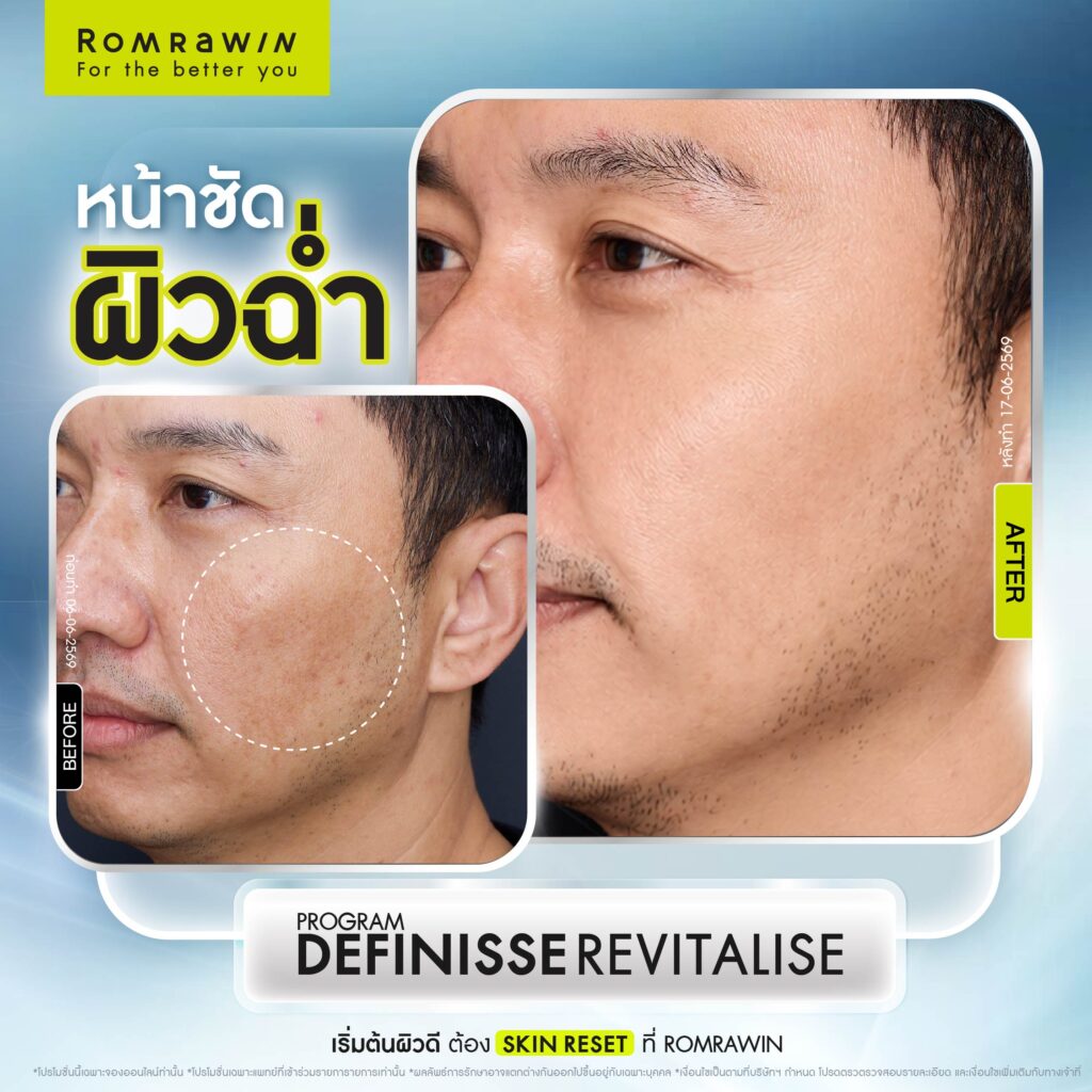 Definisse Revitalise ไหมงานผิว คืนความอ่อนวัยและแข็งแรงให้ผิวถึงระดับโครงสร้าง 6 รีวิว Definisse Revitalise