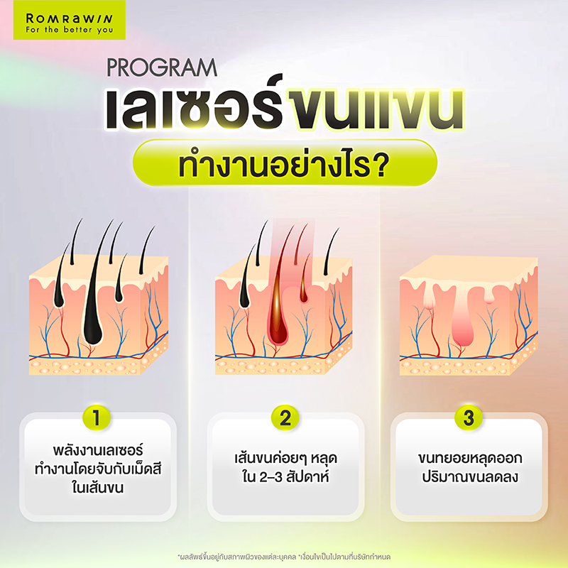 เลเซอร์ขนแขน ทางลัดสู่ผิวเรียบเนียนแบบไม่ต้องโกน 3 เลเซอร์ขนแขนทำงานอย่างไร?