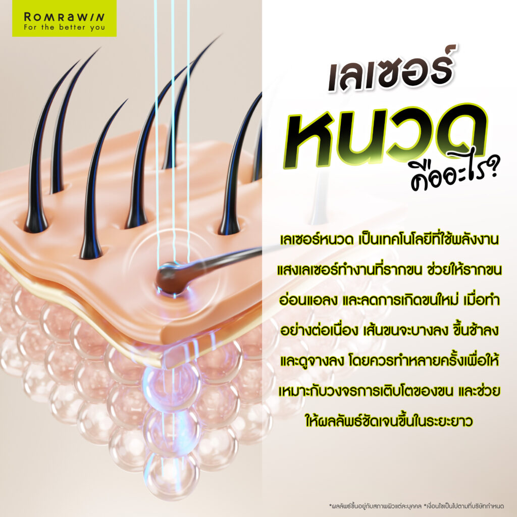 กำจัดหนวด เลเซอร์หนวดอย่างมั่นใจ ยับยั้งวงจรขนเกิดใหม่ 2 เลเซอร์หนวด กำจัดหนวด คืออะไร? ทำงานอย่างไร