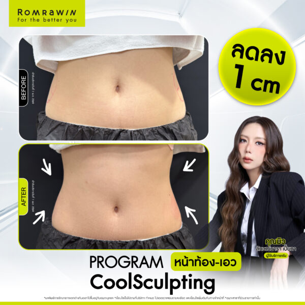 All Review 172 รีวิว Cool Sculpting หน้าท้อง คุณมิว
