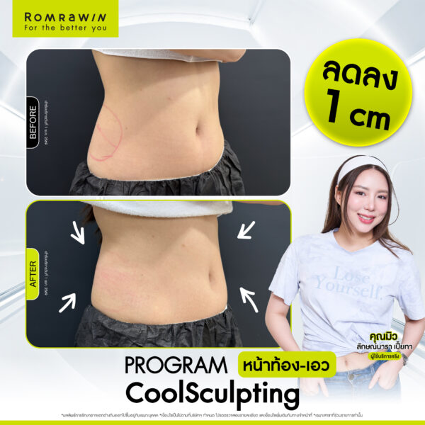 All Review 173 รีวิว Cool Sculpting หน้าท้อง คุณมิว
